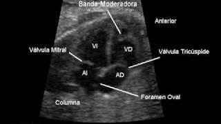 Ecocardiografía Fetal 4 camaras Normal [upl. by Yelrahc]