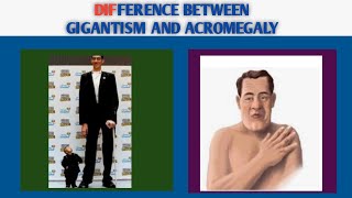 Guyton76part6 Difference between Gigantism and acromegaly [upl. by Remy196]