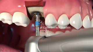 Protocole de pose de l’implant Straumann® TLX [upl. by Weide173]