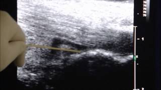 UltrasoundGuided Injection Treatment of Retrocalacaneal Bursitis [upl. by Jasun]