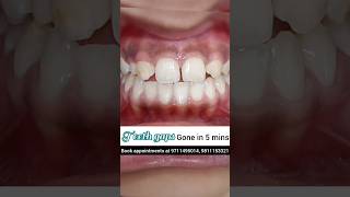 Teeth Gaps gone in just 5 minutes No braces Dr Srishti Bhatia smilemakeover dentist [upl. by Atsillak]