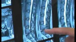 Introduction Lumbar Micro Discectomy Part 1 Jack Chen MD [upl. by Anaahs]