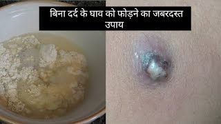 बिना दर्द के घाव को फोड़ने का जबरदस्त उपाय  ulcer skincare skincaretips [upl. by Dammahum]