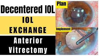 Decentered IOL Ant vitrectomy secondary lens implantation  Principles planning amp implementation [upl. by Delfine]