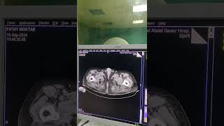 Distended gallbladder mucocele amp dilated CBD with minimal IHBR [upl. by Saile]