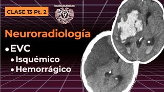 132  Neuroradiología EVC isquémico y hemorrágico [upl. by Nally]