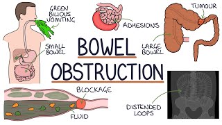 Understanding Bowel Obstruction [upl. by Gennifer]