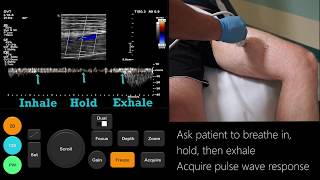 Ultrasound Tutorial DVT  Lower Limb Veins  Radiology Nation [upl. by Alan]