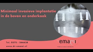 Implantaat implantatie zonder operatie flapless gehemelte vrije prothese [upl. by Rengaw]