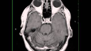 Paraneoplastic Cerebellar Atrophy [upl. by Oker382]