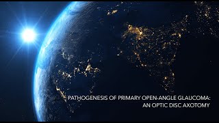 Pathogenesis of Primary Open Angle Glaucoma An Optic Disc Axotomy  Syed S Hasnain MD glaucoma [upl. by Somar]