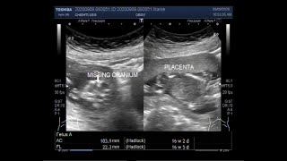 Ultrasound Video showing Anencephaly with Pregnancy of about 16 weeks 04 days [upl. by Sams254]