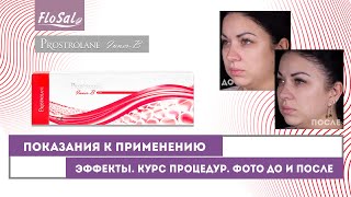 Prostrolane InnerB ПОКАЗАНИЯ К ПРИМЕНЕНИЮ ЭФФЕКТЫ КУРС ПРОЦЕДУР ФОТО ДО И ПОСЛЕ [upl. by Ettenhoj247]