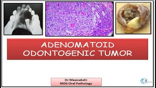 Adenomatoid odontogenic Tumor [upl. by Anelrac]