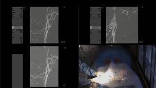 Balloon angioplasty and stenting of severe carotid stenosis [upl. by Snilloc]