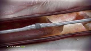 Coronary Orbital Atherectomy [upl. by Assetan]