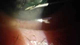 Eye Needle for Recurrent Corneal Erosion RCE [upl. by Adah]