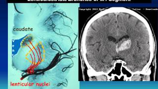 MedPix COW 674  Hypertensive Hemorrhage [upl. by Ethbinium]