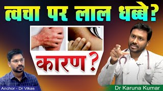 Red Spots over Skin  Causes for Purpura and Excessive bleeding  Dr Karuna Kumar  Hematologist [upl. by Flowers148]