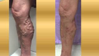 Varicose Vein Cases  varicose vein treatment before and after pictures [upl. by Mccandless]