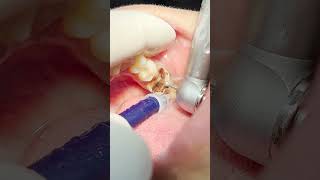 Deep tooth caries That tooth will be gonerdentist health teethcleaning 🦷beadrepair [upl. by Sherborn423]