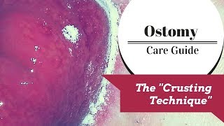 The Ostomy Crusting Technique Explained [upl. by Harlene]