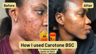 How to get clear skin Carotone Black Spot Corrector  How I truly got rid of my hyperpigmentation [upl. by Anesuza]