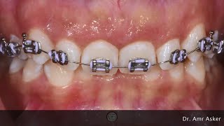 Braces timelapse  Deep Bite progress [upl. by Nahsrad685]