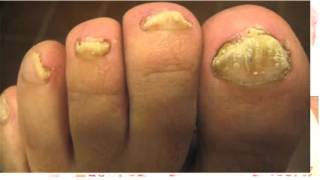 fungus toenail [upl. by Ingram]