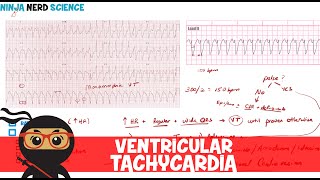 Rate and Rhythm  Ventricular Tachycardia [upl. by Aggappera]