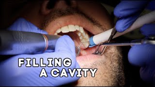 How Does A Dentist Fill A Cavity [upl. by Oicnerual]