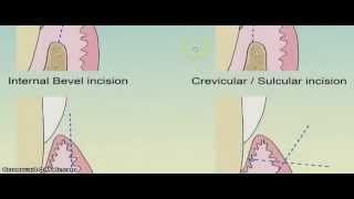 How to put internal bevel incision [upl. by Danice]