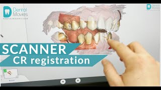 CR centric relation registration using dental intraoral scanner Primescan [upl. by Bone]