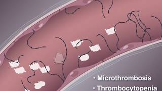 Improving Outcomes in TTP [upl. by Thrift]