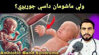 Amniotic Band Syndrome Causes in Pashto by Dr Mustaqeem [upl. by Rollo]