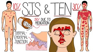 Understanding StevensJohnson Syndrome and Toxic Epidermal Necrolysis SJS amp TEN [upl. by Cull]