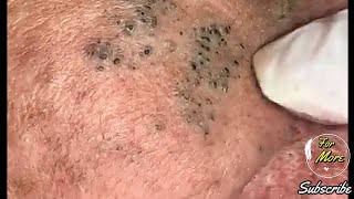 Dr Pop  Deep Blackheads in old Skin removing amp treatment 2020 Part 4 HD [upl. by Ahsienat]