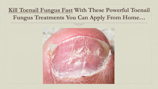 Kill Toenail Fungus Fast With This Powerful Toenail Fungus Treatment You Can Apply From Home [upl. by Syman675]