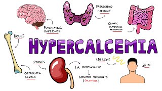 An Approach to Hypercalcemia  Causes Calcium Homeostasis Mechanisms amp Signs and Symptoms Mnemonic [upl. by Oiretule]