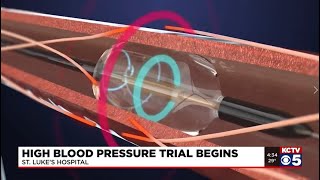 KCTV  Renal Denervation Helping Patients Combat Hypertension [upl. by Aitan202]