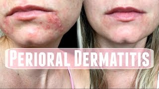 Perioral Dermatitis How I treated it [upl. by Ehc]