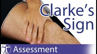 Clarkes Sign  Patellar Grind Test  Patellofemoral Pain  Chondromalacia Patellae [upl. by Pinkerton]