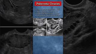 Polycystic Ovaries PCOs 💯❤️ polycysticovarysyndrome ovary pregnancy medical ultrasound health [upl. by Occer]