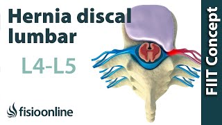 Hernia discal lumbar entre la L4 y L5 o cuarta y quinta vértebras lumbares [upl. by Mose719]