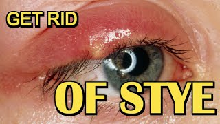 How To Get Rid Of Stye Fast  Removal At Home [upl. by Fablan]