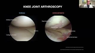 Adipose Cells to treat Knee Osteoarthritis [upl. by Ramirol]