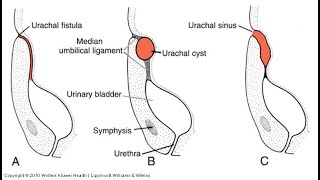 URACHAL ABNORMALITIES [upl. by Aciamaj603]