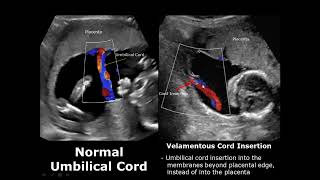 Umbilical Cord Ultrasound Normal Vs Abnormal Image Appearances Comparison  Fetal USG  Obstetric [upl. by Pius89]