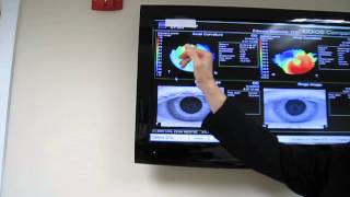 AN EXPLANATION OF CORNEAL TOPOGRAPHY AND KERATOCONUS [upl. by Wilbert]