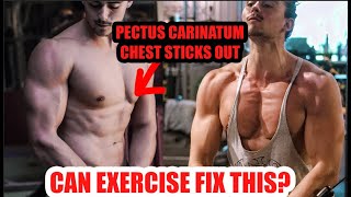 Exercise to Fix PECTUS CARINATUM [upl. by Ocinom]